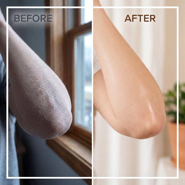 Best Body Butter for Dry Skin: Benefits, Ingredients & How To Use It